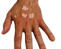 Remedies for Vitiligo 1
