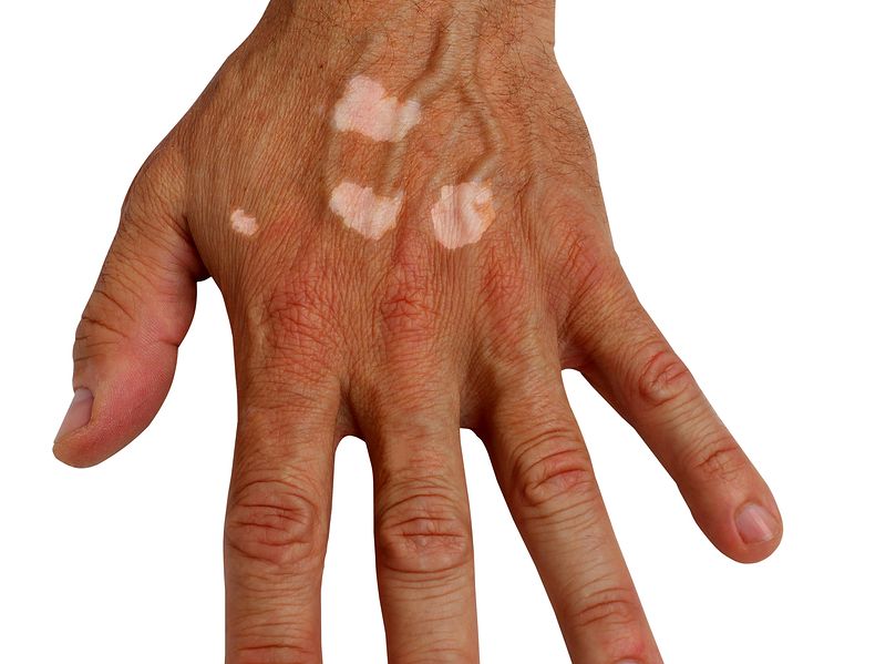 Remedies for Vitiligo 2