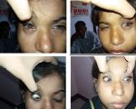 Conjunctivitis Case: Allergic Conjunctivitis Case: Allergic Conjunctivitis 1