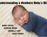 Skin 1 Remedies for Infant Skin Remedies for Infant Skin 1
