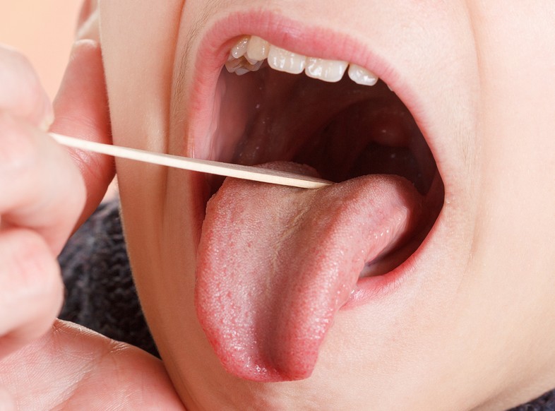 Remedies for Tonsillitis 2