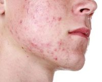 Study: Homeopathy for Acne 7
