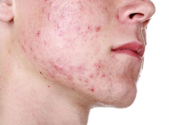 Study: Homeopathy for Acne 2