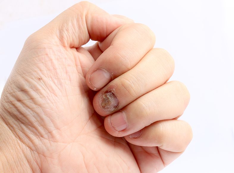 Management of Nail Disorders 2