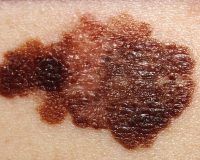 Study: Melanoma Cells 'Suicide' with Homeopathy 8