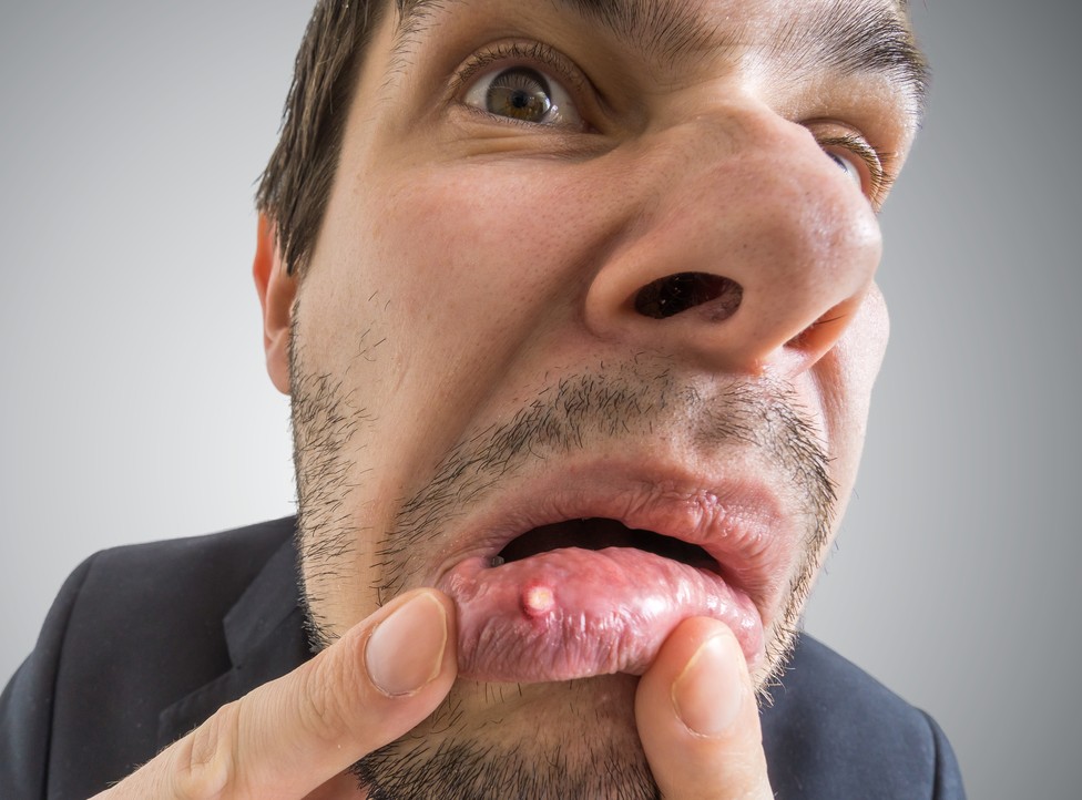 Remedies for Mouth Ulcers 2