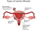 Homeopathic Help for Fibroids 1