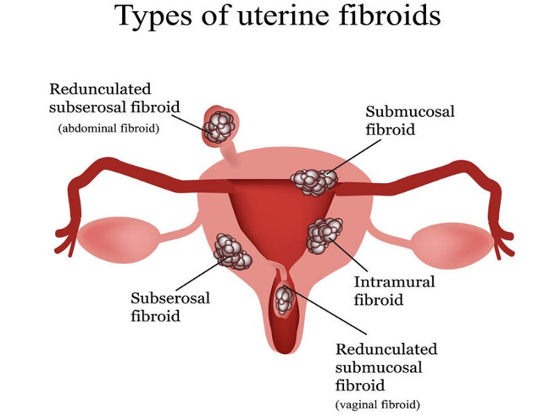 Homeopathic Help for Fibroids 2