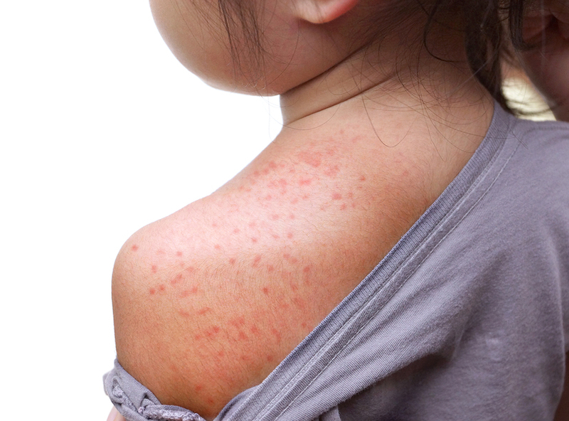 Measles and Homeopathy 2
