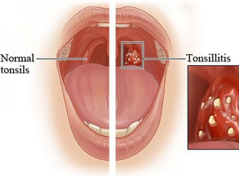 Acute Tonsilitis and Homeopathy 2
