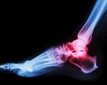 Homeopathy and Gout 2