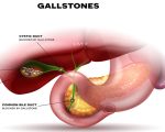 Remedies for Gallstones 2