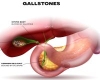 Remedies for Gallstones 1