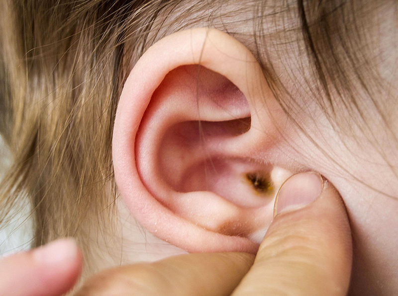 Troubled Ears and Homeopathy 2