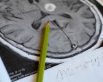 Stroke Strokes and Homeopathy Strokes and Homeopathy 1