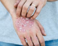 Psoriasis and Homeopathy 1