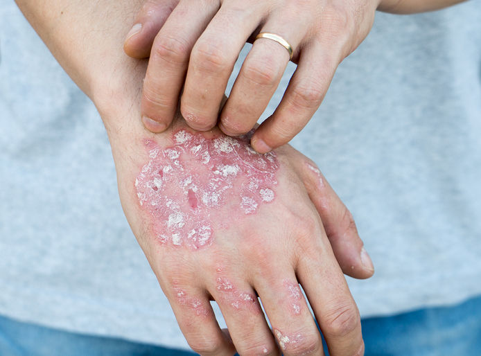 Psoriasis and Homeopathy 1