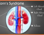 Conns Remedies for Conn’s Syndrome Remedies for Conn’s Syndrome 1