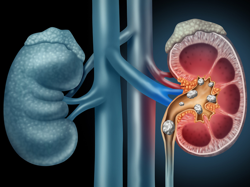 Dissolving Kidney Stones 2