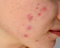 Homeopathy for Acne 6