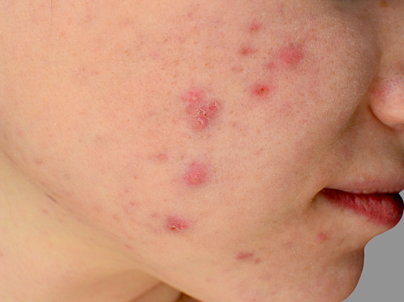 Homeopathy for Acne 2