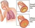 Bronchitis Homeopathy for Bronchitis Homeopathy for Bronchitis 1