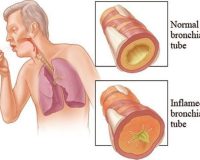 Homeopathy for Bronchitis 9