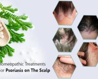 Remedies for Scalp Psoriasis 5