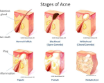 acne Remedies for Acne and Scars Remedies for Acne and Scars 1