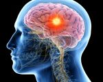 Brain Disease Homeopathy for Brain Disease Homeopathy for Brain Disease 1