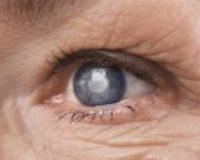 Effective Remedies for Cataracts 2