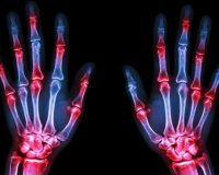 Remedies for Finger Joint Pain 8