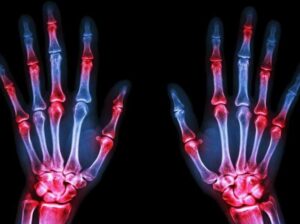 Remedies for Finger Joint Pain