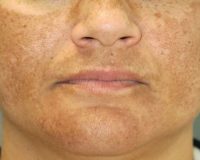 Homeopathy for Melasma, Chloasma 2