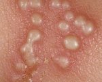 Shingles Shingles & Homeopathy Shingles & Homeopathy 1