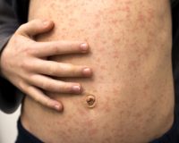 Homeopathy and Measles 8