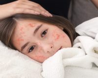 Homeopathy and Measles? 3