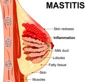 Homeopathy for Mastitis 5