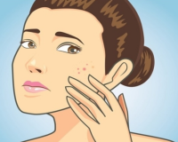 Acne and Homeopathy 7
