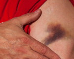 Bruises Healing Bruises With Homeopathy Healing Bruises With Homeopathy 1