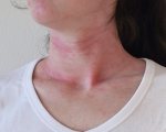 Urticaria Remedies for Urticaria Remedies for Urticaria 1