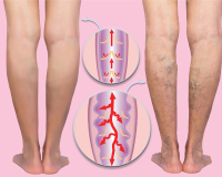Remedies for Varicose Veins 1