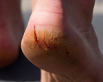 Heel 1 Remedies for Heel Cracks Remedies for Heel Cracks 1
