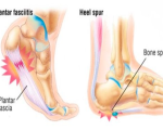 Heel Remedies for Heel Pain Remedies for Heel Pain 1