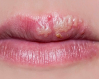 Remedies for Cold Sores 7