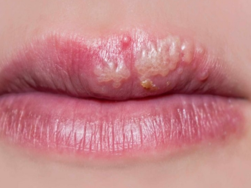 Remedies for Cold Sores 10