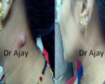 abscess Homeopathy for Abscess Homeopathy for Abscess 1