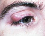 Chalazion Homeopathy for Chalazion Homeopathy for Chalazion 1