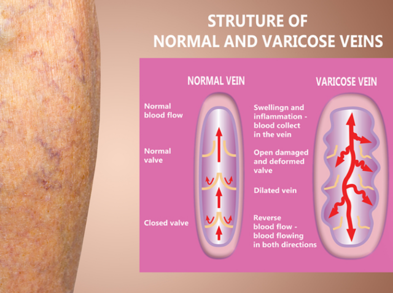 Remedies For Varicose Veins | Homeopathy Plus