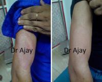 Remedies for Ringworm and Fungal Infections 2